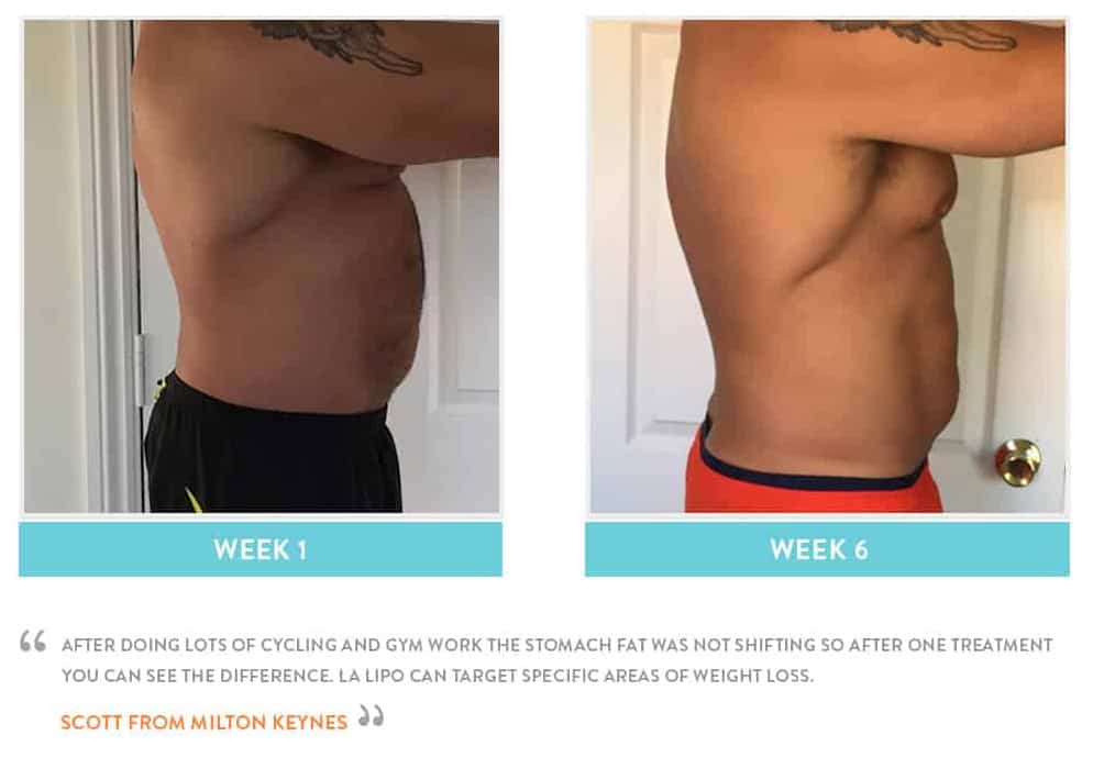 Before & After Stomach Fat Winchmore Hill
