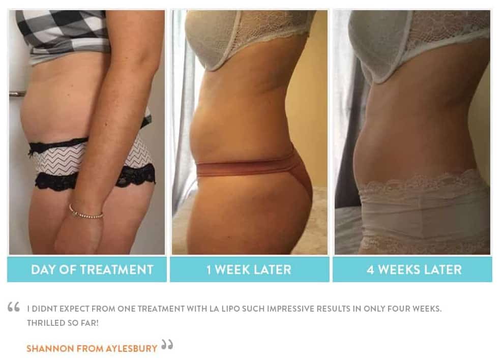 before, Cryolipolysis Winchmore Hill