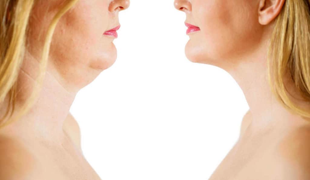 Double Chin treatment Winchmore Hill before and after results