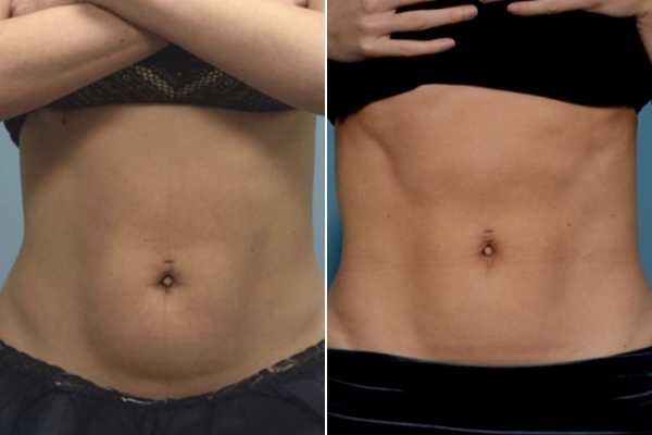 body sculpting FAQs Winchmore Hill