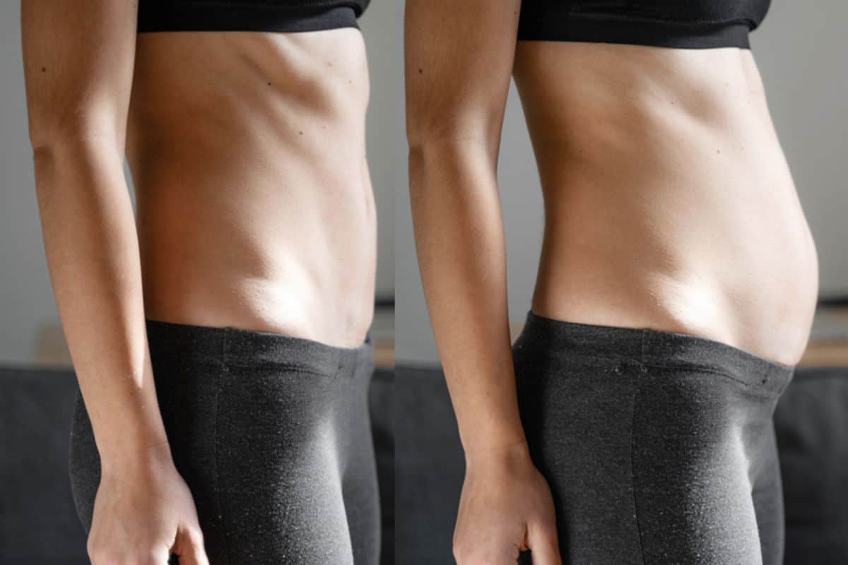 How long does diastasis recti take to improve Winchmore Hill?