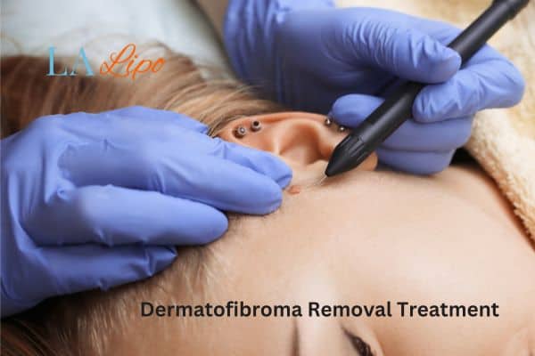 Dermatofibroma Removal Treatment Winchmore Hill