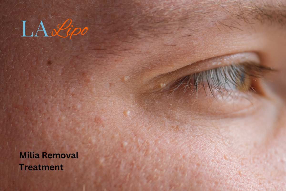 Cryopen Milia Removal: Is It the Easiest and Safest Option Winchmore Hill?