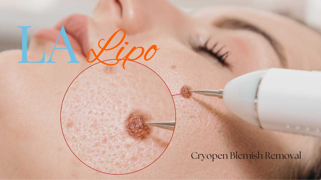 cryopen blemish removal Winchmore Hill Contact our team today!