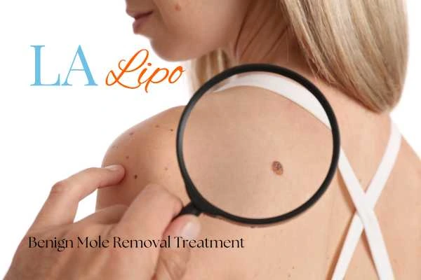 Woman having her inspection of blemish before mole removal Winchmore Hill