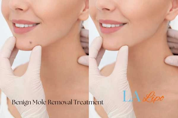 woman's before and after mole removal Winchmore Hill results