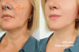 hi-fu for wrinkles Winchmore Hill before and after results