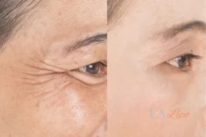 Before and after results of woman - HI-fu wrinkles reduction treatment Winchmore Hill