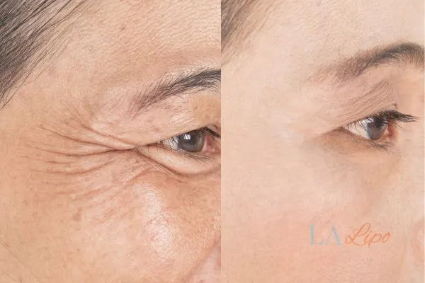 Before and after results of woman - HI-fu wrinkles reduction treatment Winchmore Hill