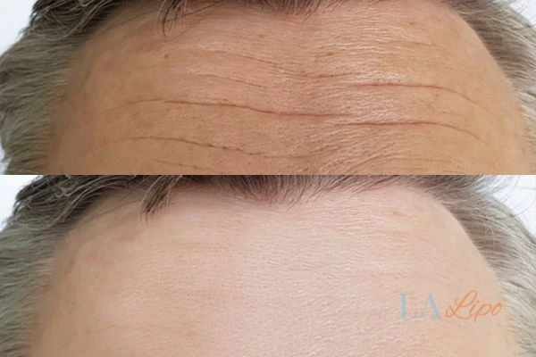 results of HIFU Winchmore Hill on mans forehead to help reduce lines and wrinkles