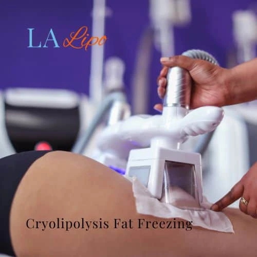 fat freezing - Cryolipolysis Winchmore Hill
