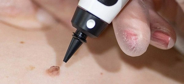 skin tag removal using cryopen Winchmore Hill