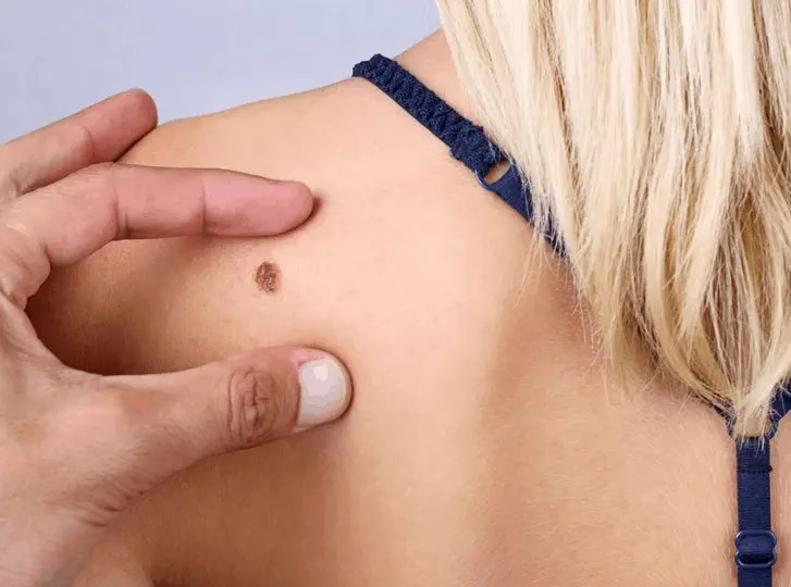 woman having mole removal Winchmore Hill consultation before treatment.