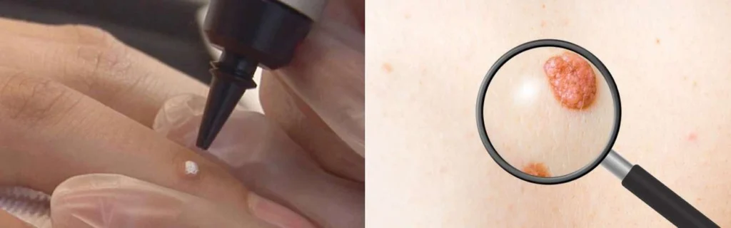 Person getting moles removed with cryopen Winchmore Hill