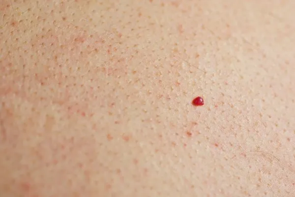 close up of a cherry angioma Winchmore Hill