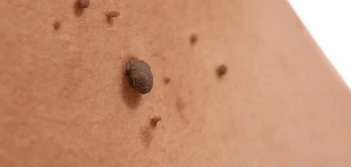 image of a skin tag Winchmore Hill