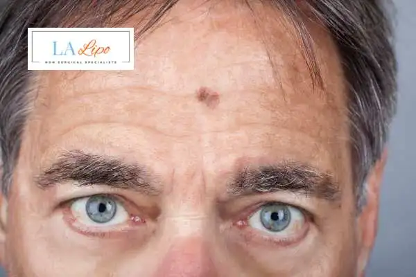 Solar Lentigo Removal Winchmore Hill image of man with mark on his forehead
