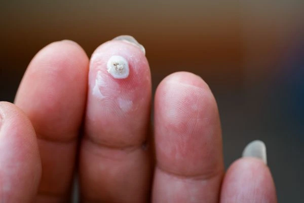 wart on person finger - cryotherapy to treat from LA LIPO Winchmore Hill