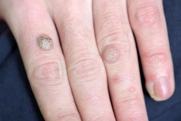 photo of warts on person hand - see wart removal Winchmore Hill from LA LIPO