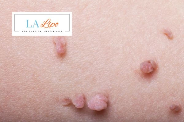 Does cryopen skin tag removal Winchmore Hill hurt? Find out now call our team today!