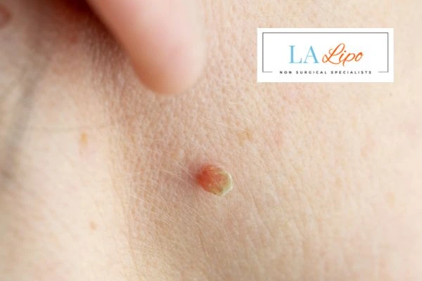 Book skin tag removal Winchmore Hill today speak to our team now!