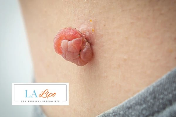 Interested in skin tag removal Winchmore Hill? Concerned about the pain? Find out more today!