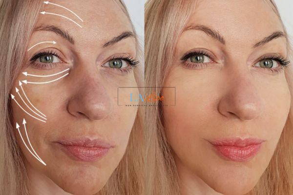 Morpheus 8 results Winchmore Hill face lift.