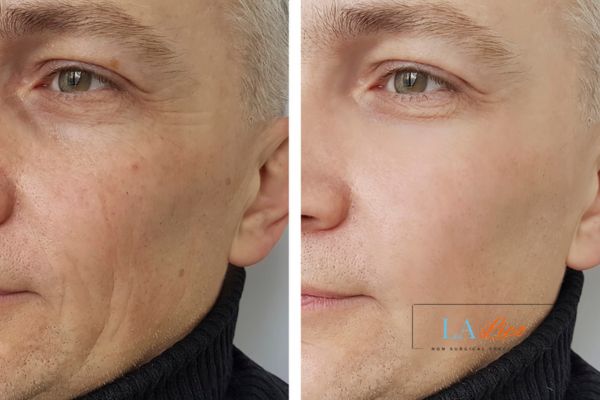 See the amazing results of Morpheus8 Treatment Winchmore Hill!