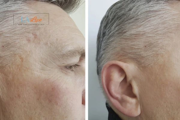 Mens Before & After Morpheus 8 Results Winchmore Hill