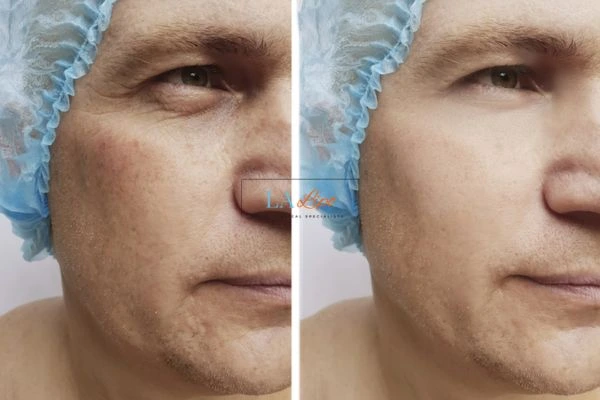 Before and after Morpheus 8 Results Winchmore Hill