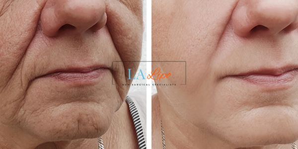 Older lady deeper wrinkle reduction - LA LIPO Morpheus 8 Results Winchmore Hill