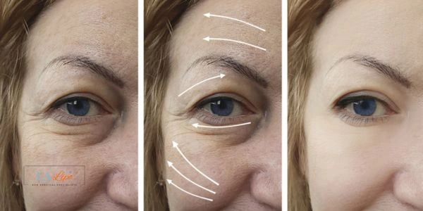 Amazing eye lift Morpheus 8 results Winchmore Hill