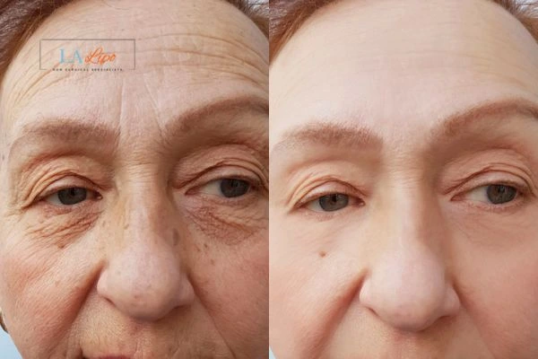 The powerful benefits of Morpheus8 Treatment Winchmore Hill - Call Our team today!