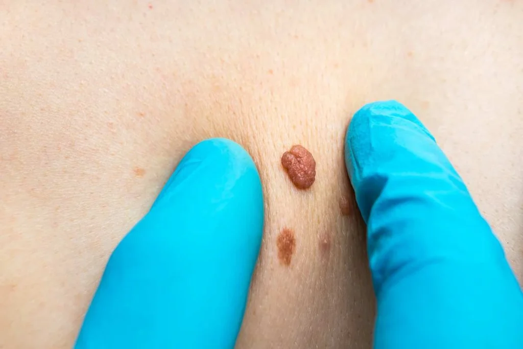 LA LIPO Cryopen Lesion Removal Prices Winchmore Hill