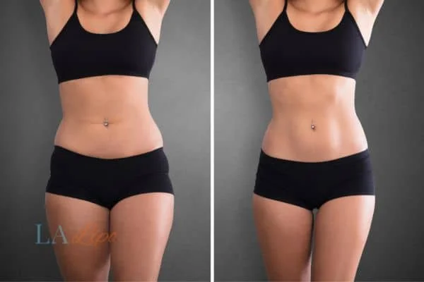 before and after results of non-surgical treatment to help a woman's body image and mental health Winchmore Hill