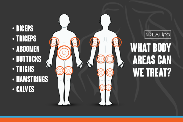 Diagram to show areas you can have LA-EMS Body Sculpting Treatment Winchmore Hill