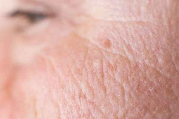 close up picture of a woman's face showing an age spot Winchmore Hill