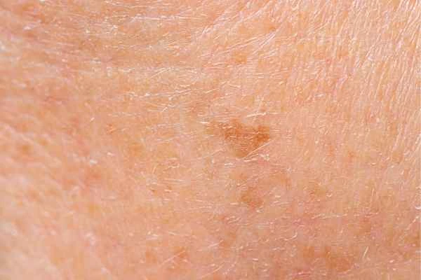 close up picture of age spots Winchmore Hill