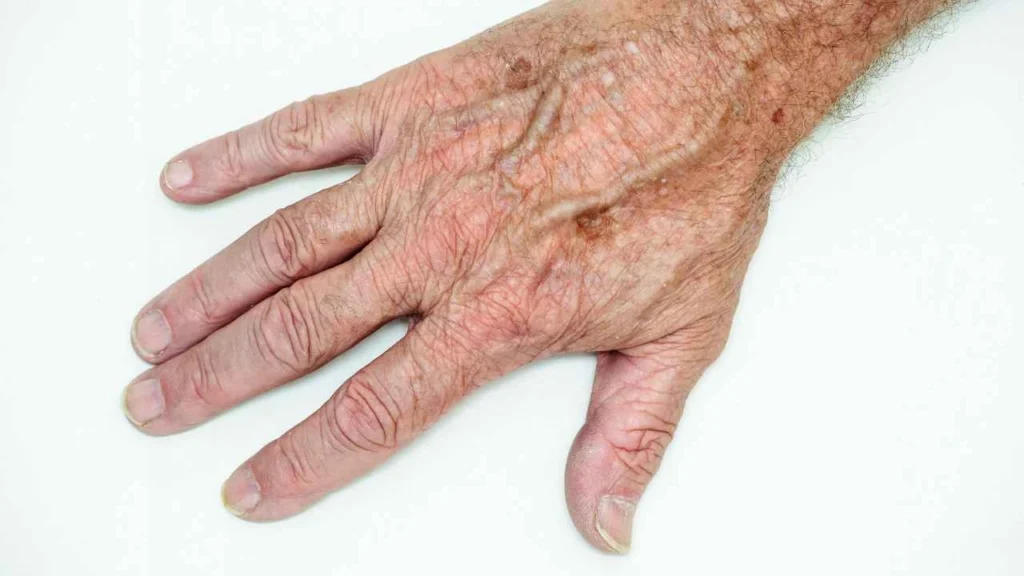 Male hand showing age spot Winchmore Hill