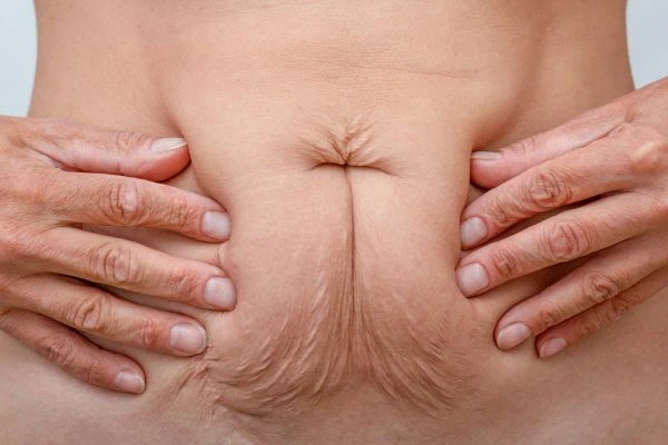 Image of a woman's stomach with loose skin - example of skin tightening Winchmore Hill options