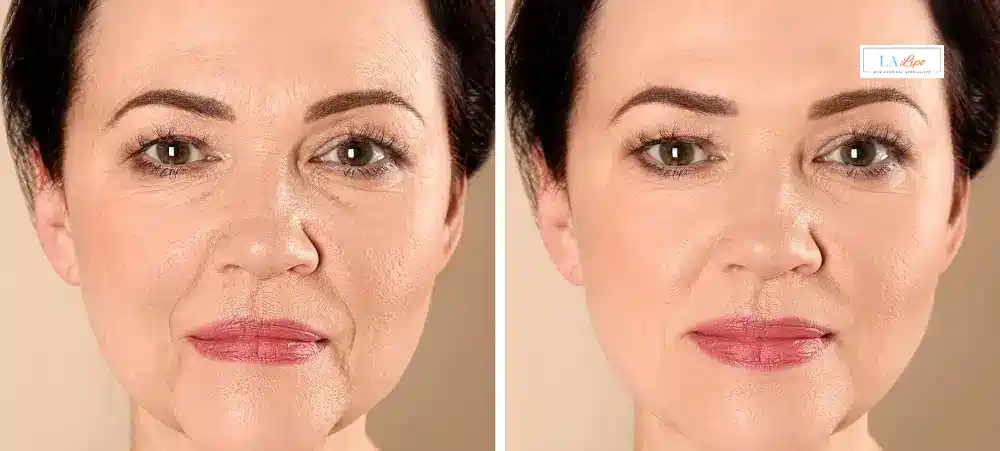 How Long Does It Take to See Results and How Long Do They Last Winchmore Hill?