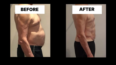 What Symptoms Can Diastasis Recti Cause in Men? Weak Core, Back Pain and Poor Posture Winchmore Hill